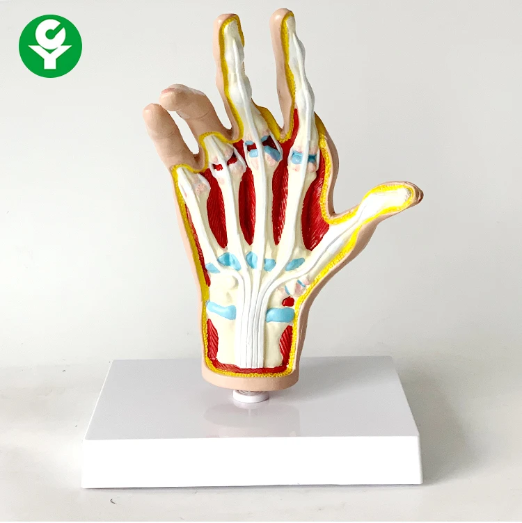Anatomical model of human hand joint   Arthritis    Rheumatic fever