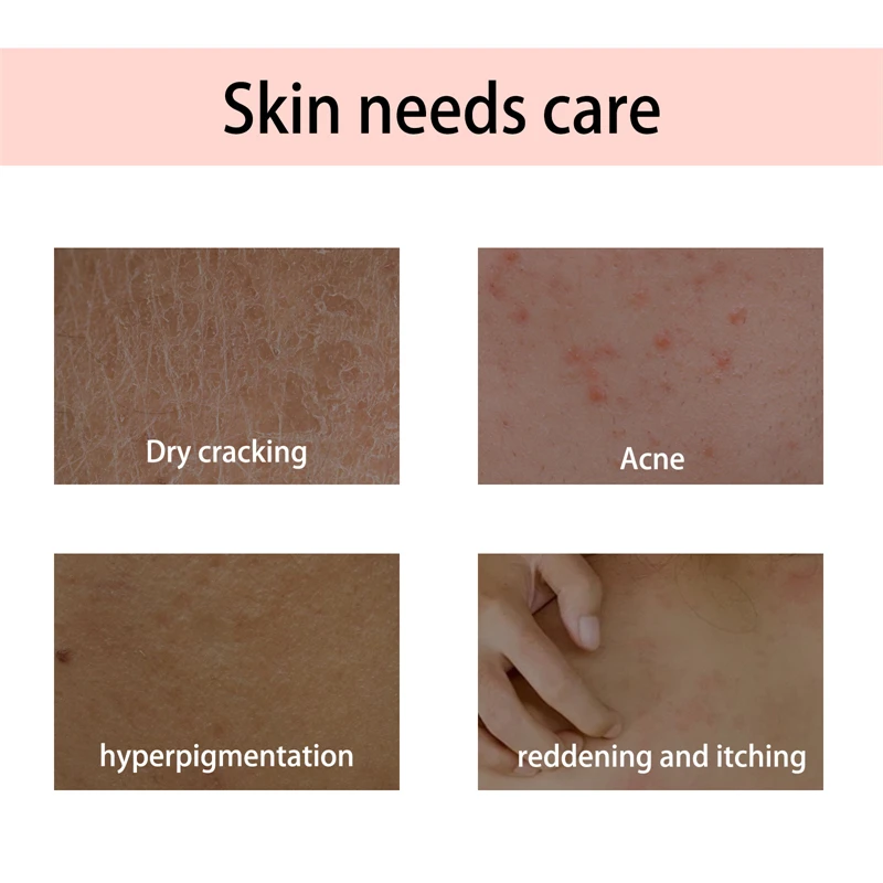 OceAura body juice moisturizing softening tightening dry cracking acne redness itch relieving body oils for the body dry skin