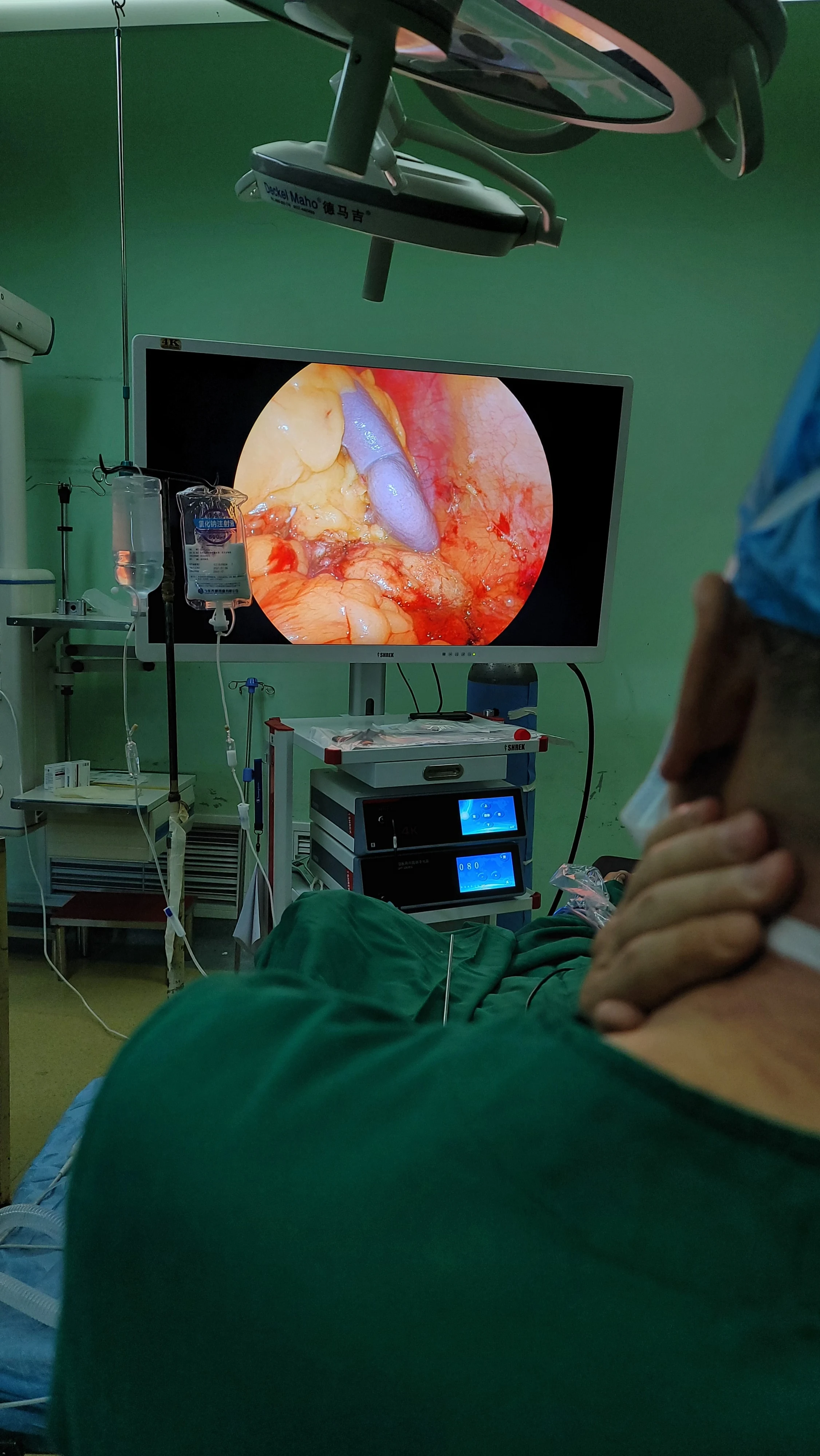 Shrek Medical Rigid 4k Laparoscopic Camera System