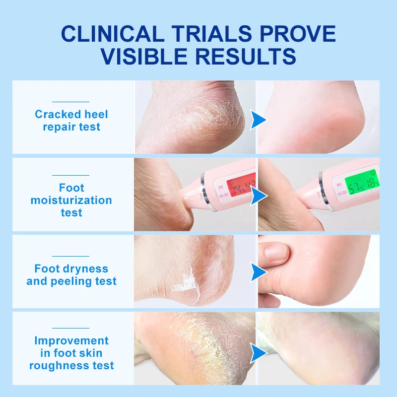 Hot selling 40% urea foot cream organic Deep Moisturizing Cracked Heel Treatment Dead Skin Removal Peeling foot cream