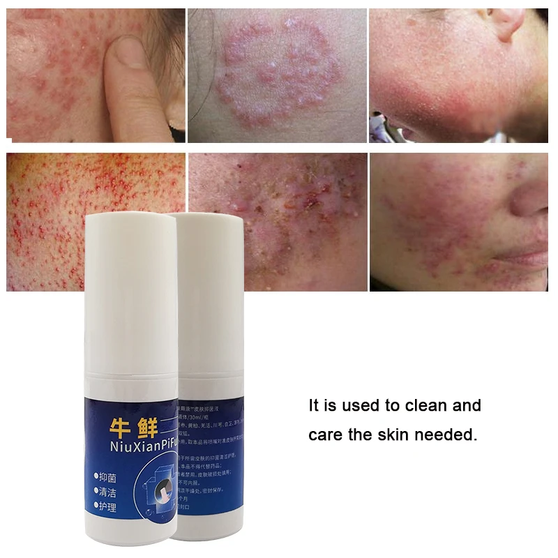 ZB Psoriasis Spray Herbal Extracts Dermatitis Eczema Ointment Psoriasis Skin Care Antibacterial Spray