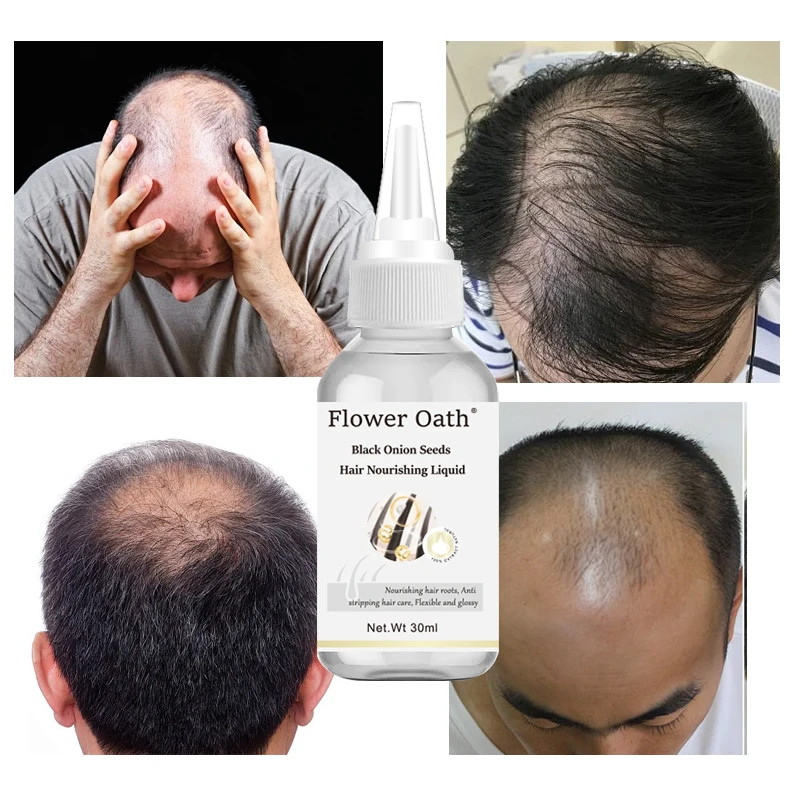 Flower Oath onion rosemary black seed extract hair growth hair loss preventing oily hair scalp treatment liquid Growth Serum