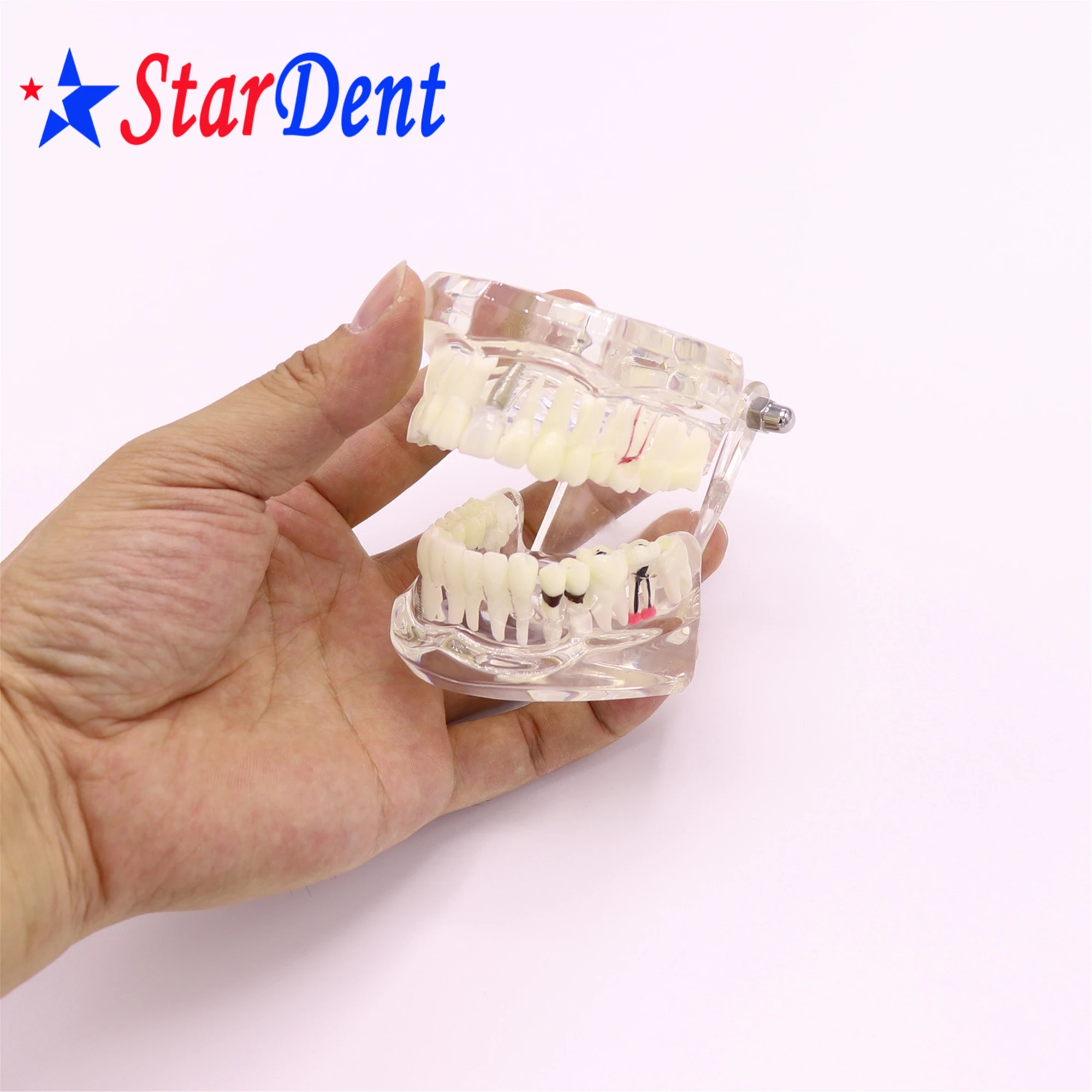 Dental  Teeth Implant Model For Tooth Implant Practicing