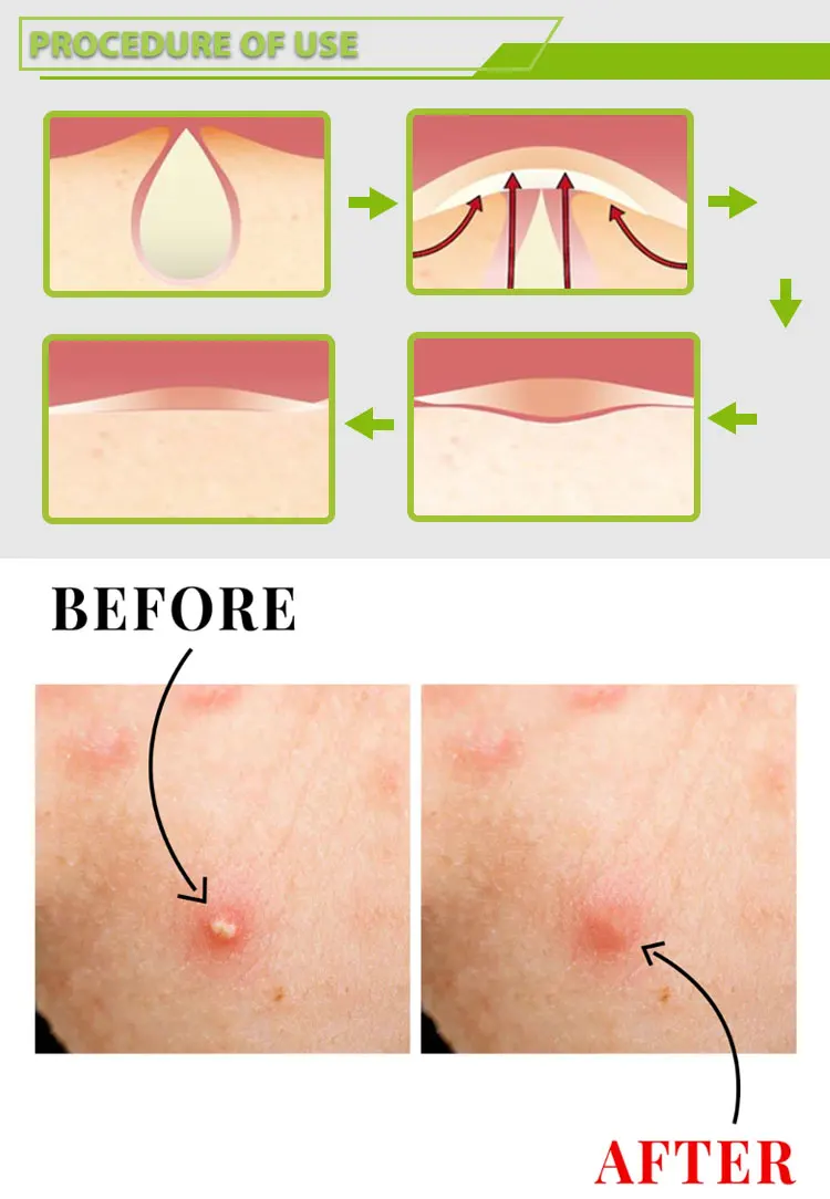 Private Label Clear Acne Custom Pimple Patch Stickers With Tea Tree Oil