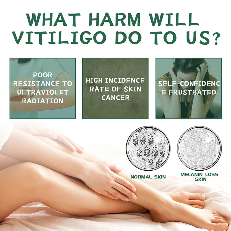 Vitiligo Cream Get rid of ringworm White spots Get rid of skin vitiligo Eliminate vitiligo