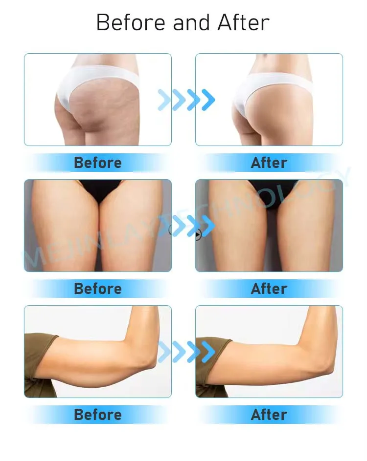 MJL New Turbo G8 Vibrator Vacuum Heat 2 in 1 Handle Butt Vibrating Lifting body Massage Device