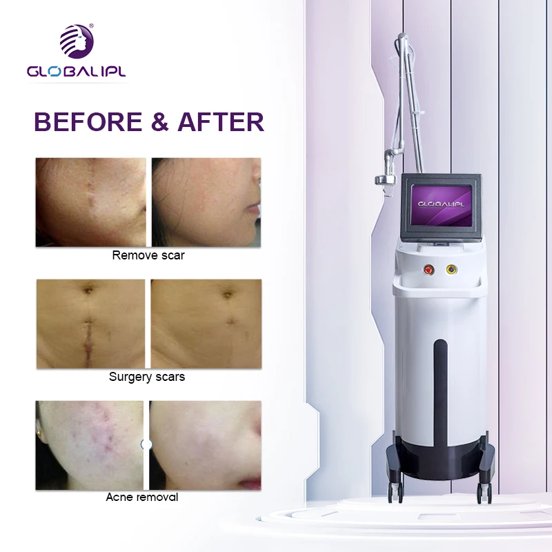 Vaginal Repair 2024 New Multiple Treatment Parameters Skin Rejuvenation Beijing GLOBALIPL Co2 Laser Machine for Scar Removal