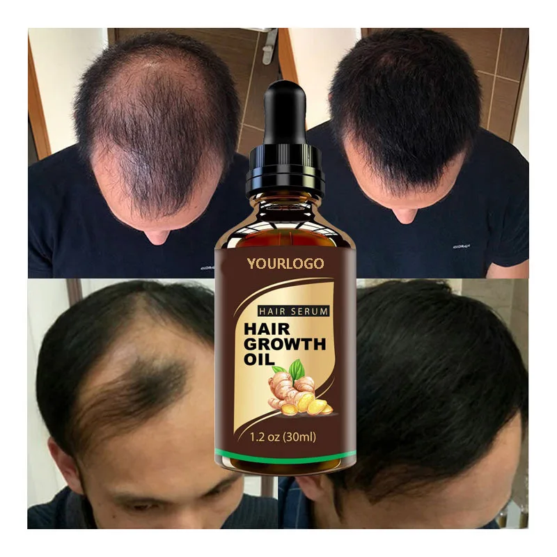Hair Growth Oil Anti-hair Loss Serum Private Label 30ml Scalp Growth Hair Treatment For Woman Man