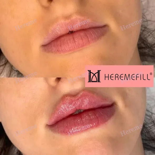 Heremefill Newest Hyaluronic Pen High Pressure 2 in 1 Syringe Hyaluronic Pen/Needle Free Very Cheap Hyaluronic Pen Supplier