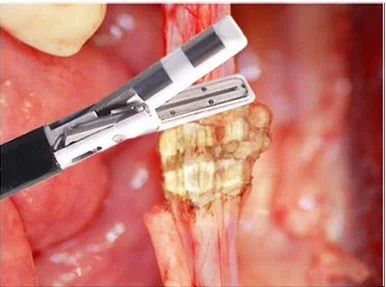 Laparoscopic ligasure vessel sealer and divider