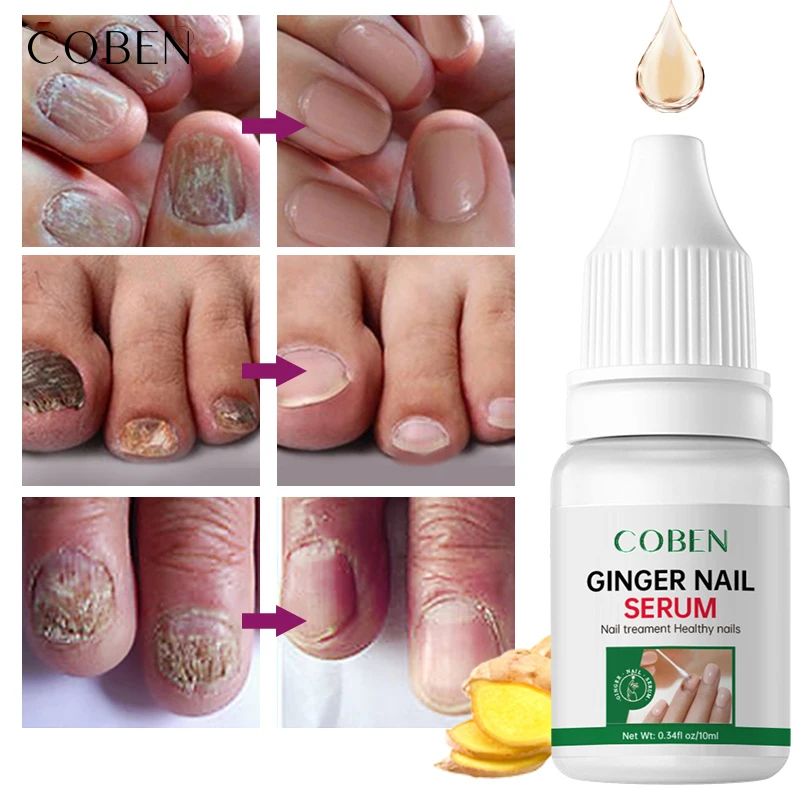 Treatment Nail Repair Pen For Onychomycosis Paronychia Finger Toenail Fungus Infection