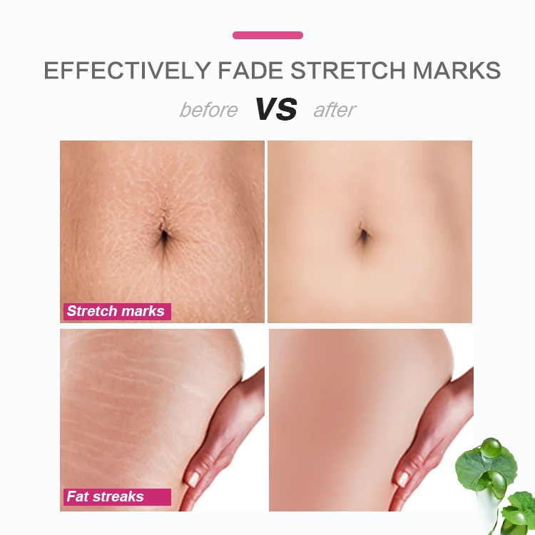 100% Effective Best Collagen Jojoba Oil Stretch Mark Cream Removal Scar Cream Nourish Intensive Treatment Stretch Mark Cream