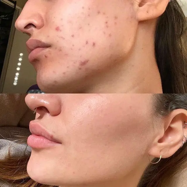 IPL OPT Long Intense Pulse Laser Pain Free Hair Removal M22 IPL Photofacial Beauty Equipment With Free IPL Lamp