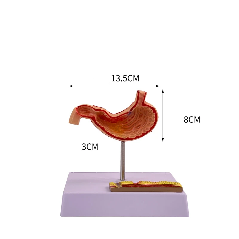 Medical Stomach Demonstration Human Stomach Anatomy Pathology Gastric Digestive System Model Gastroenterology Toy Model