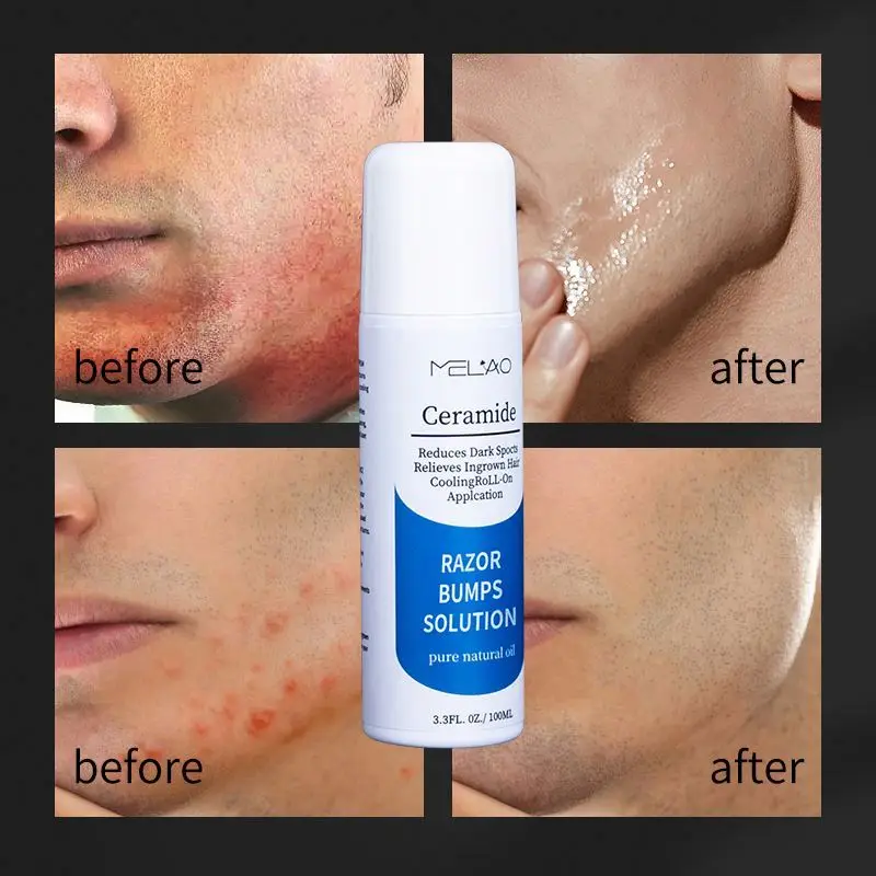 oem Roll On Solution Razor Bump Treatment After Shave Serum For Men And Women