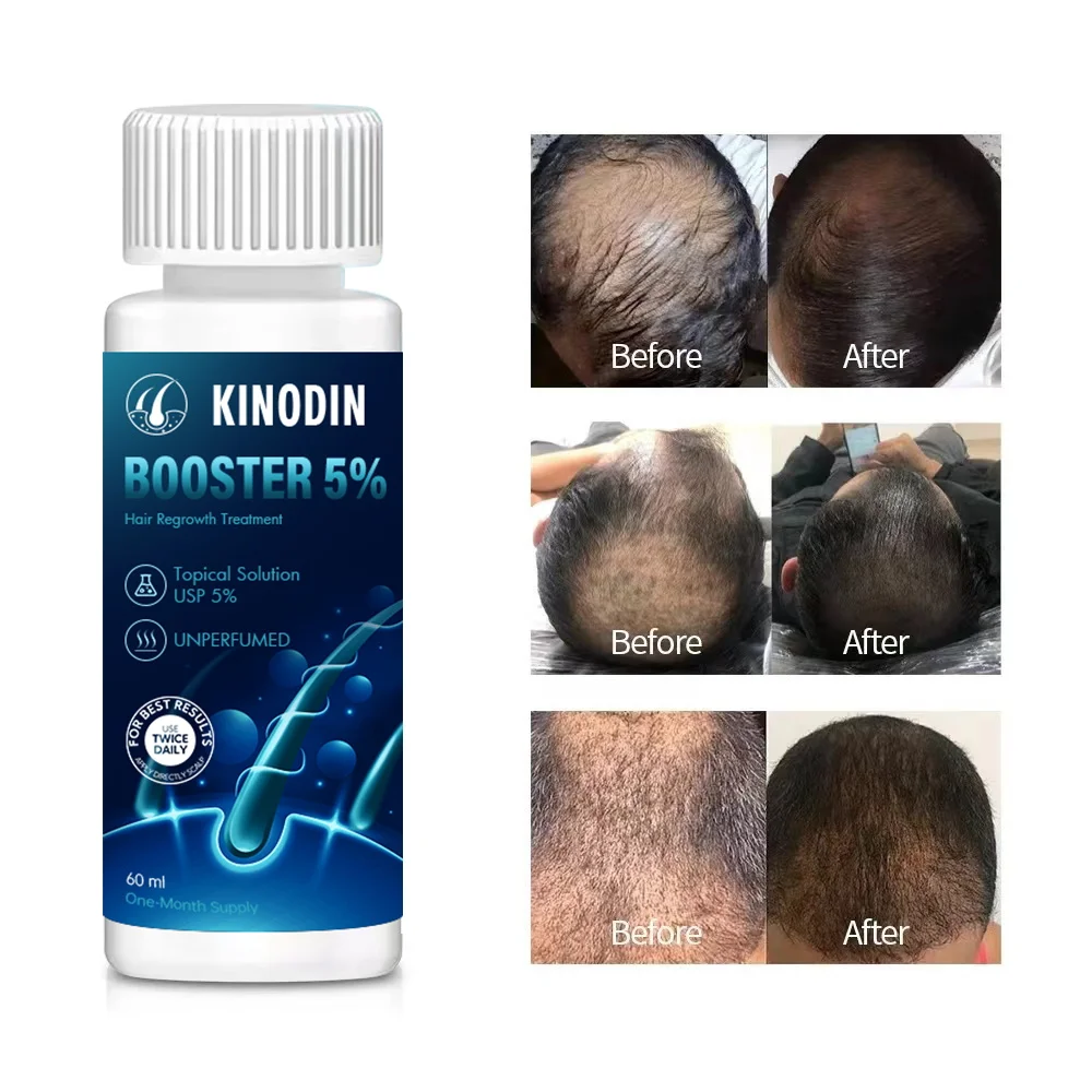 2% 5% 15% Hair Growth Oil SERUM 60ml Active Tonic Prevents Hair Loss Nourishing Hair Booster Growth Oil with Dropper