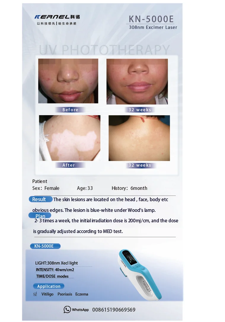 Kernel KN-5000E Portable 308nm excimer laser machine 308nm psoriasis vitiligo laser device for vitiligo treatment