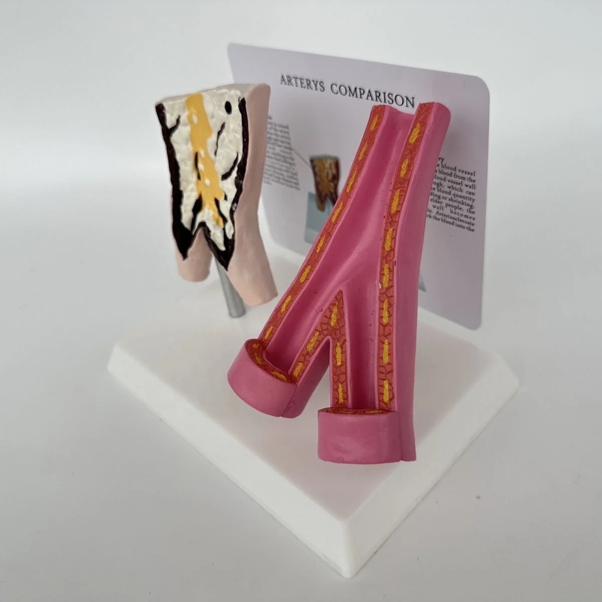 Medical Sciences Comparison Model Between Smoking Blood Vessels and Normal Blood Vessels  Artery Pathology Model