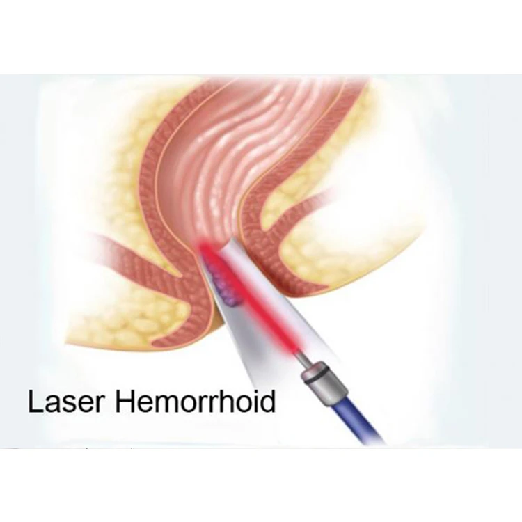 New popular 1470nm diode laser equipment for Hemorrhoids & Fistula surgery treatment