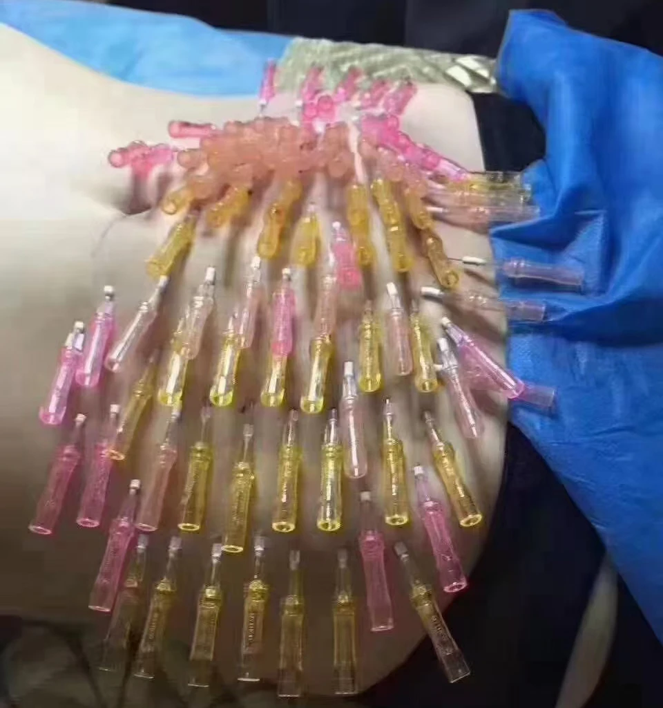 Hot Sale High Quality 27G 38mm Facelifting Facial Lifting Absorbable Tornado Thread Pdo