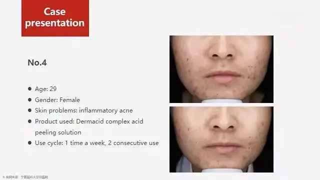 High Quality OEM Professional Beauty Salon Used 35% Anti Acne Aging Spots Mandelic Acid Salicylic Acid Chemical Peeling Gel
