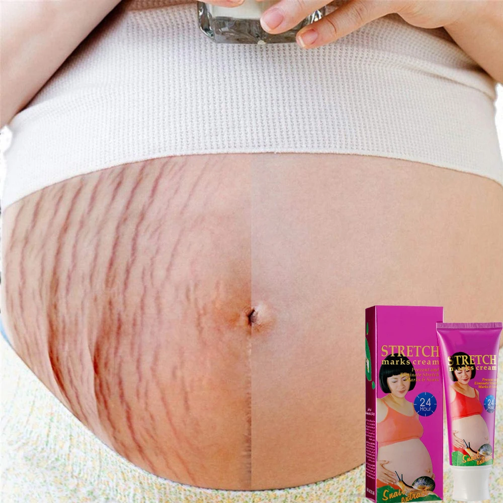 Amazon Hot Sale Best Natural Organic Herbal Repair Scar Anti Vergeture Vegan Stretch Mark Removal Cream
