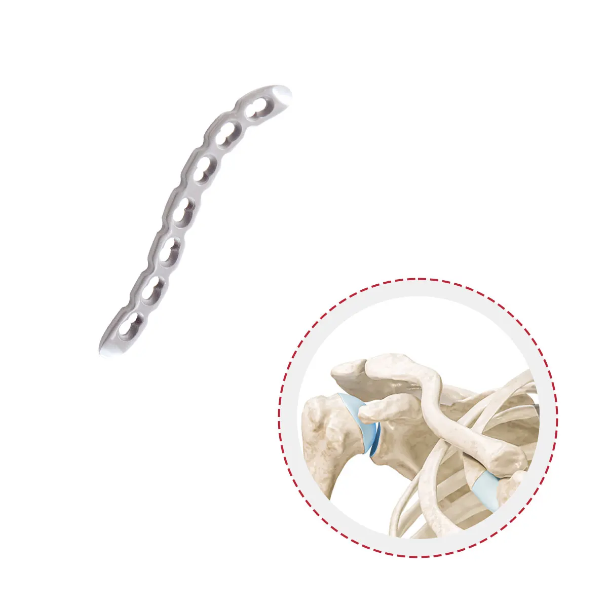 High Quality Factory Medical Orthopedic Implant Titanium S-Clavicular Locking Plate