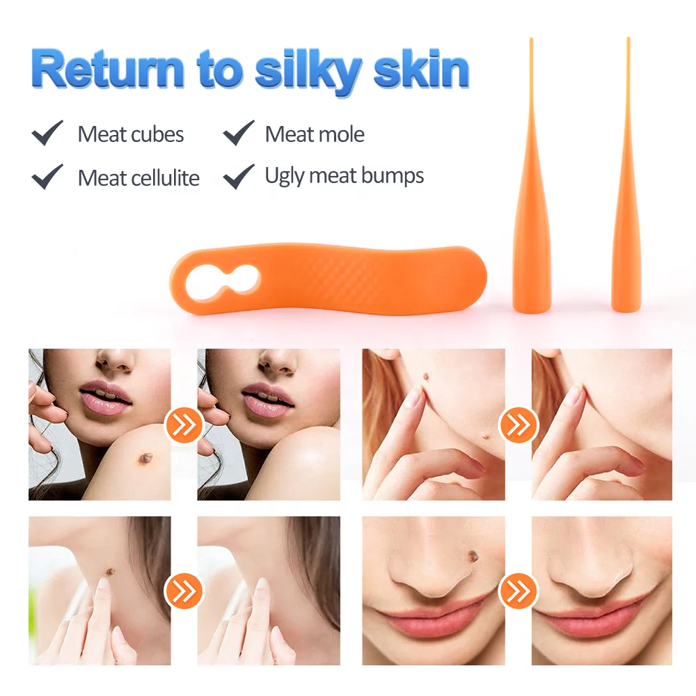 Lescolton New type 2 in 1 Different Size Skin Tag And Wart Band Removal Skin Tags On Neck Facial Body Use Painless