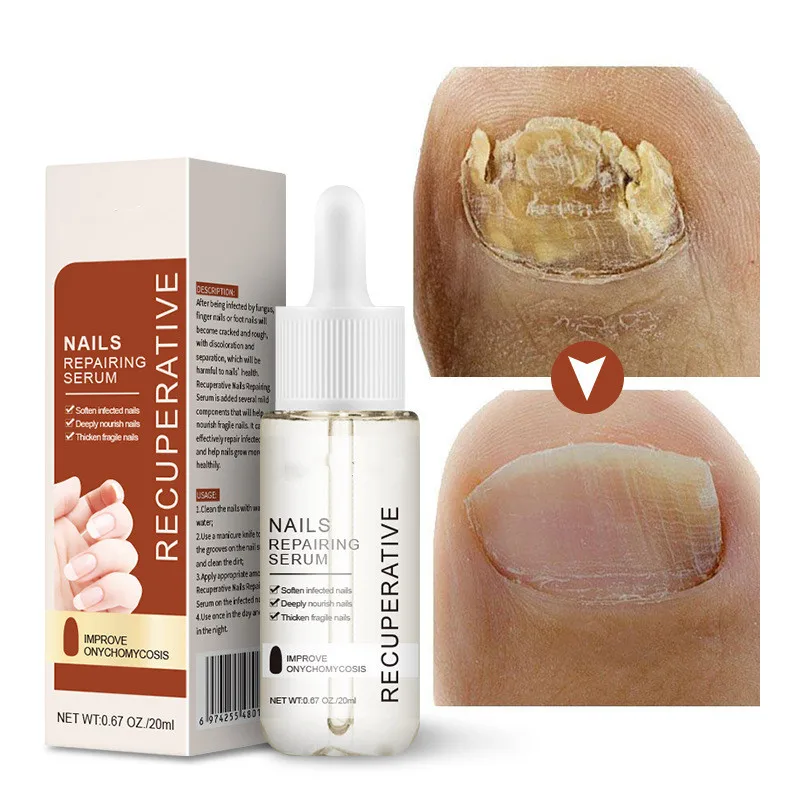 
Hot Selling Transparent Nail Fungus Repair Effective Nail Treatment Anti Fungal Nail Repair Essence Serum 