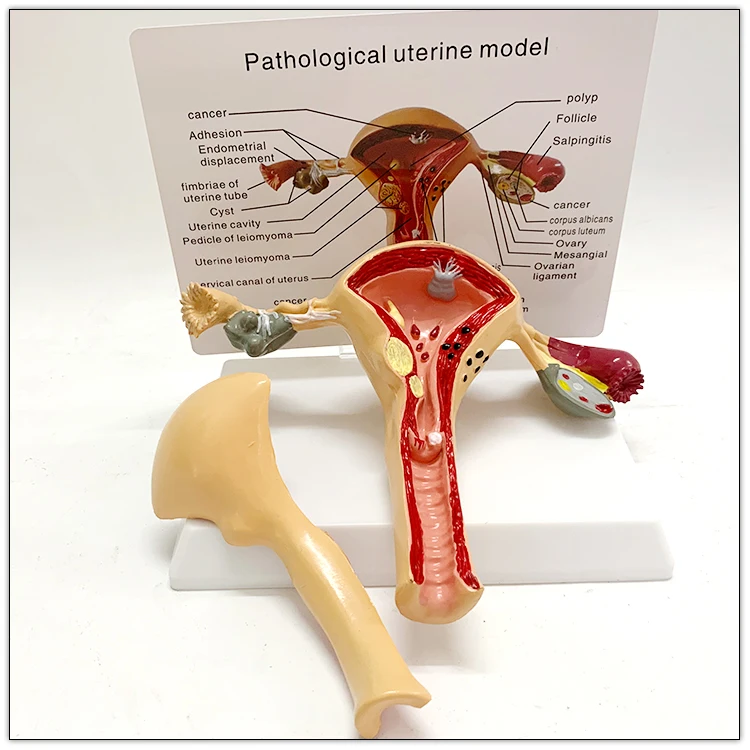 Standard price medical anatomical uterus teaching models of the uterine leiomyomas