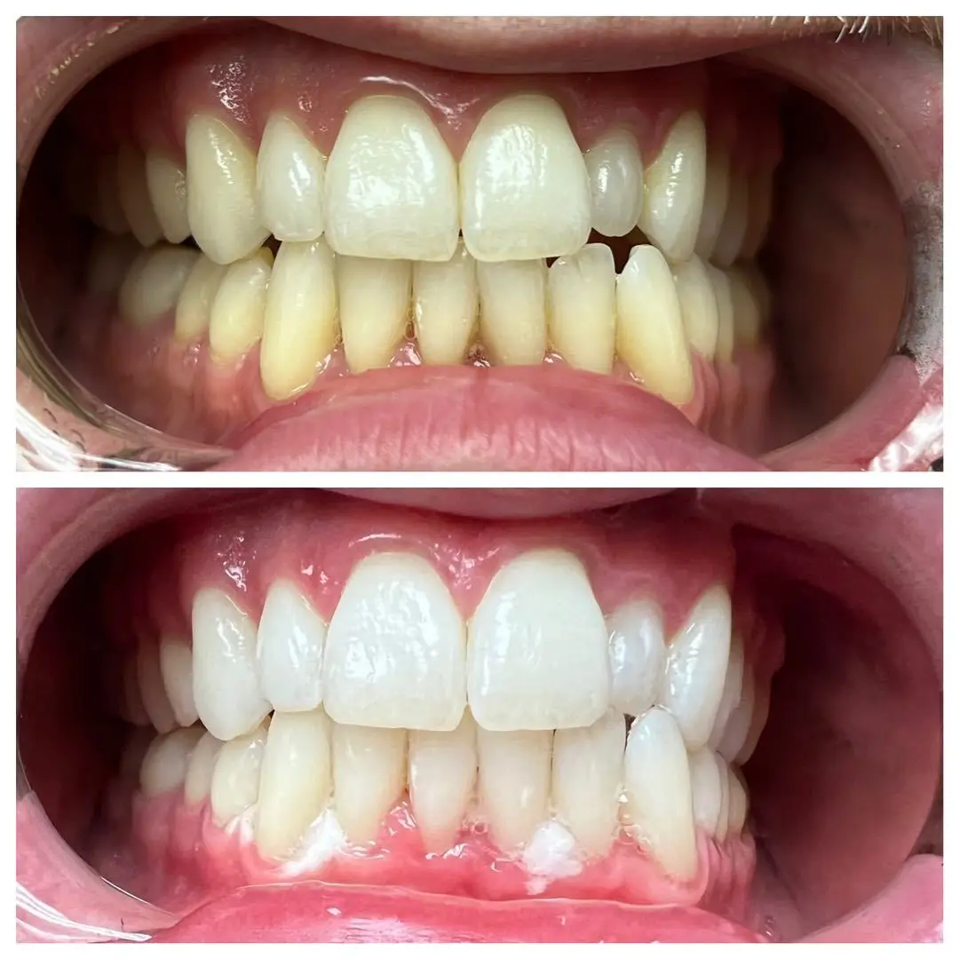 Most Strong 44% HP Dual Barrel Teeth Whitening Gel Professional Hydrogen Peroxide Tooth Bleaching Gel for Dental Office