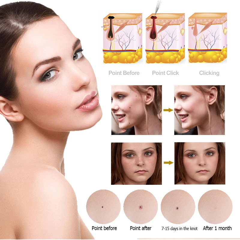 2021 remove dark black portable beauty plasma laser mole freckle spot
