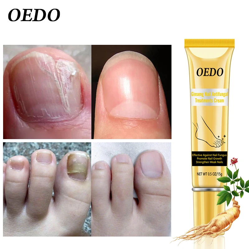  OEDO Женьшень Для ногтей противогрибковое лечение крем для удаления грибка против инфекции паронихия онихомикоз ухода за