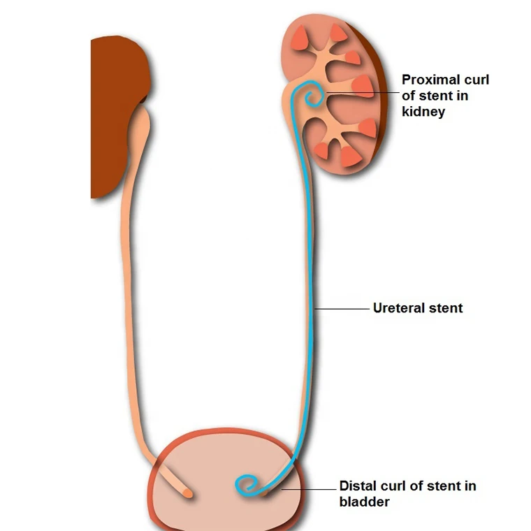 high biocompatibility multiple holes with big lumen result tapered tip ureteral stent