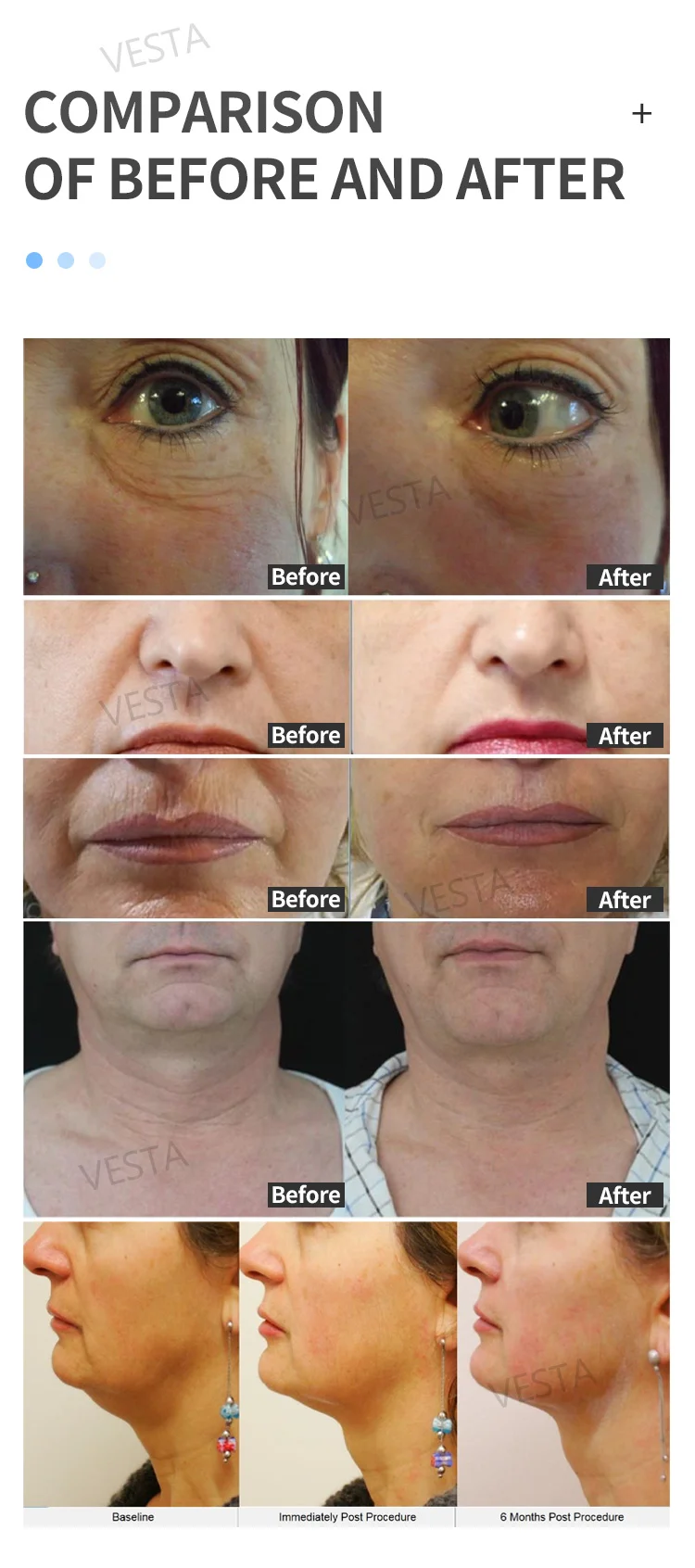 Hot Sale Products Hydra Machine Aqua Peel Solution Skin Care Rejuvenation Deep Cleansing Aqua Peeling Ultrasound Hydra Machine