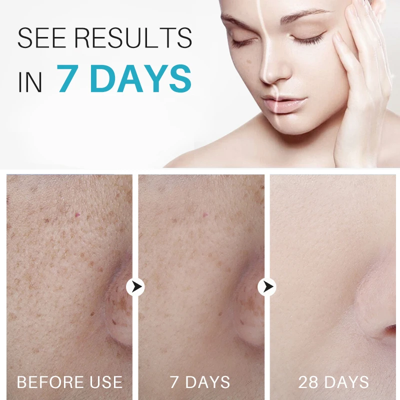 OEM 30g Natural Herbal blemish Serum Freckle Pimples Dark Spot Removal Corrector Eraser Whitening Cream