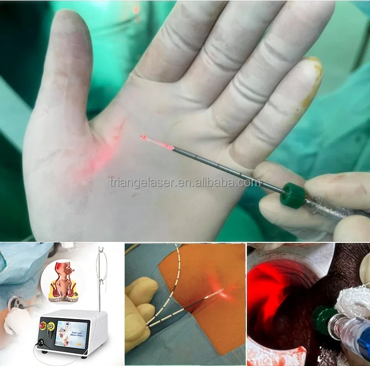 2023 Surgical device Anal Fistula and Hemorrhoids Diode Laser 1470nm 980nm Hemorrhoids Treatment surgery hemorrhoidectomy device