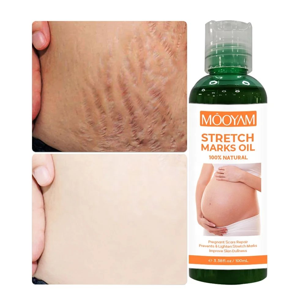 Strong Effective Stretch Mark Removal Oil Scar Remover Body Pregnancy Skin Repair Tightening Stretch Marks Oil