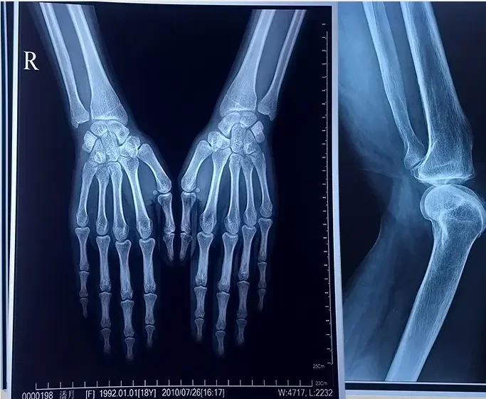 Full size blue dry thermal imaging x-ray film to be used on thermal printer
