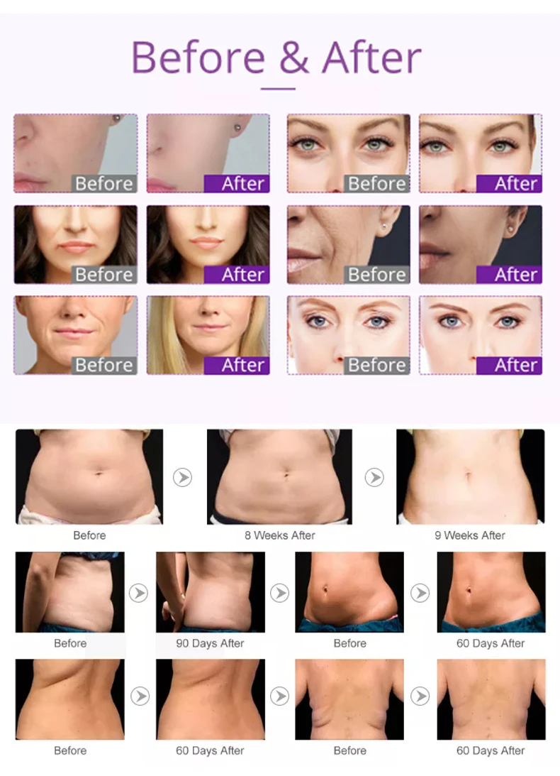 6 In 1 40khz Ultrasonic Cavitation 2.0 Rf Slimming Beauty Machine Ultra Cavitation Machine For Skin Tighten Body Sculpting