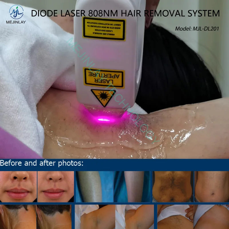 Permanent Hair Remover Diode Laser 808nm Beauty  Painless Hair Removal with Cooling Technology Machine