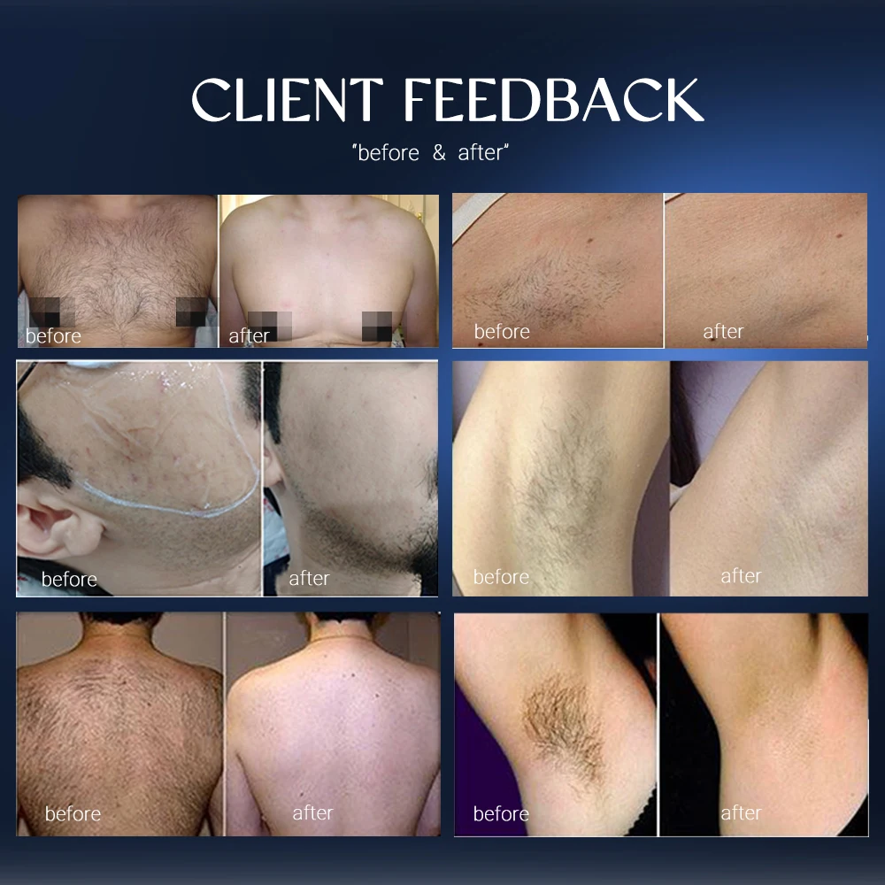 2024 Newest Diode Laser 808 Nm Medical Ce 808 Diode Laser/ 808Nm Diode Laser Hair Removal / 808 Diode Laser Beauty Machine