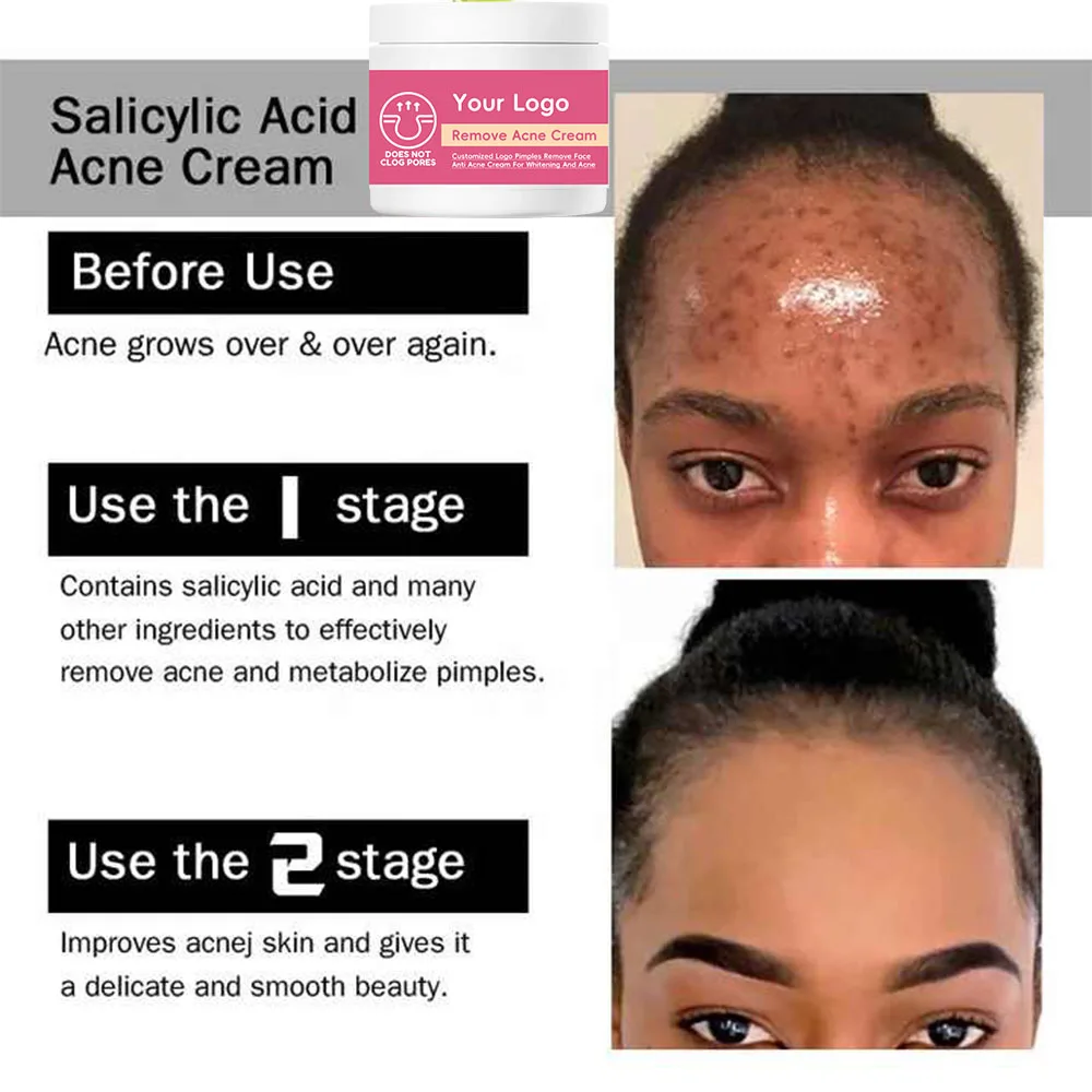 Benzoyl Peroxide Topical Pimple Cream Acne for Face Targets Blemishes Reduces Redness Calms Clears