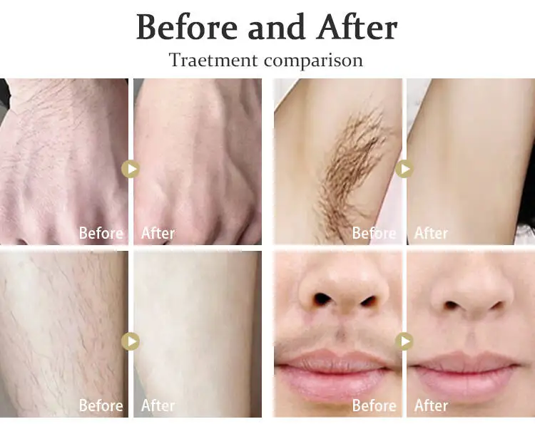 New Portable Diode Laser 755 808 1064nm 3 waves Hair Removal machine beauty equipment for home use and salon use