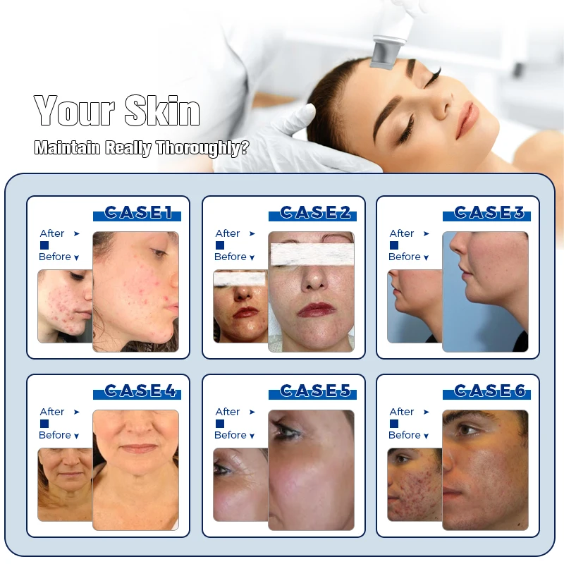 9 In 1 Face Machine Micro-touch Hydracare Domestos Diamond Dermabrasionin One Hydra Dermabrasion Hydra Dermabrasion Peel Machine