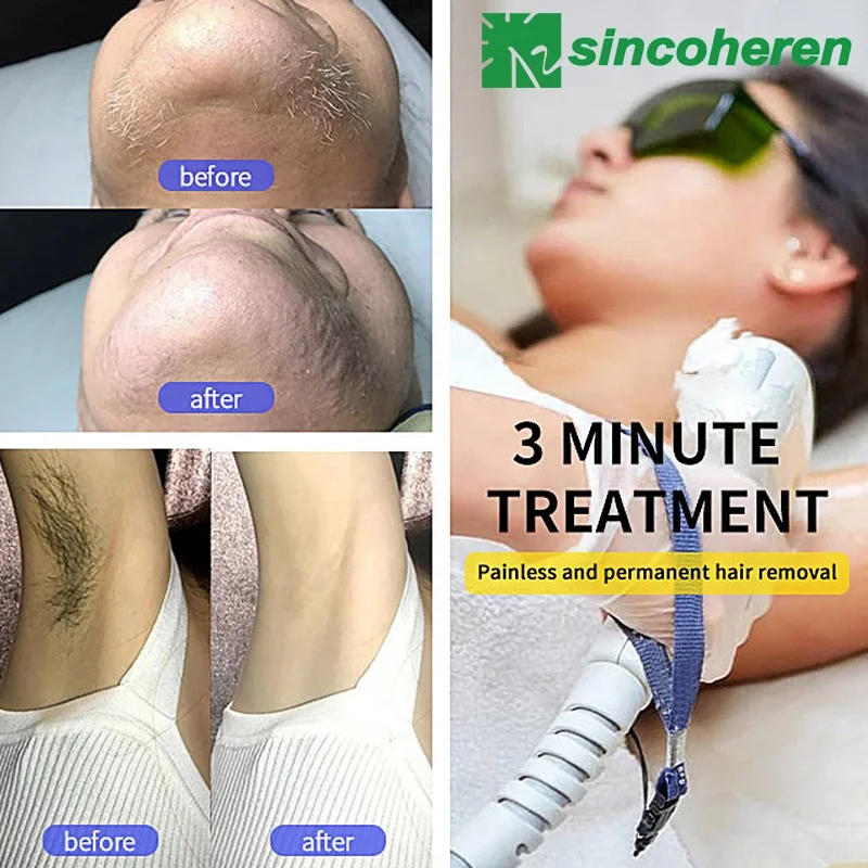 Sincoheren Professional 3 wave 755 808 1064nm diode laser hair removal machine SDL-D