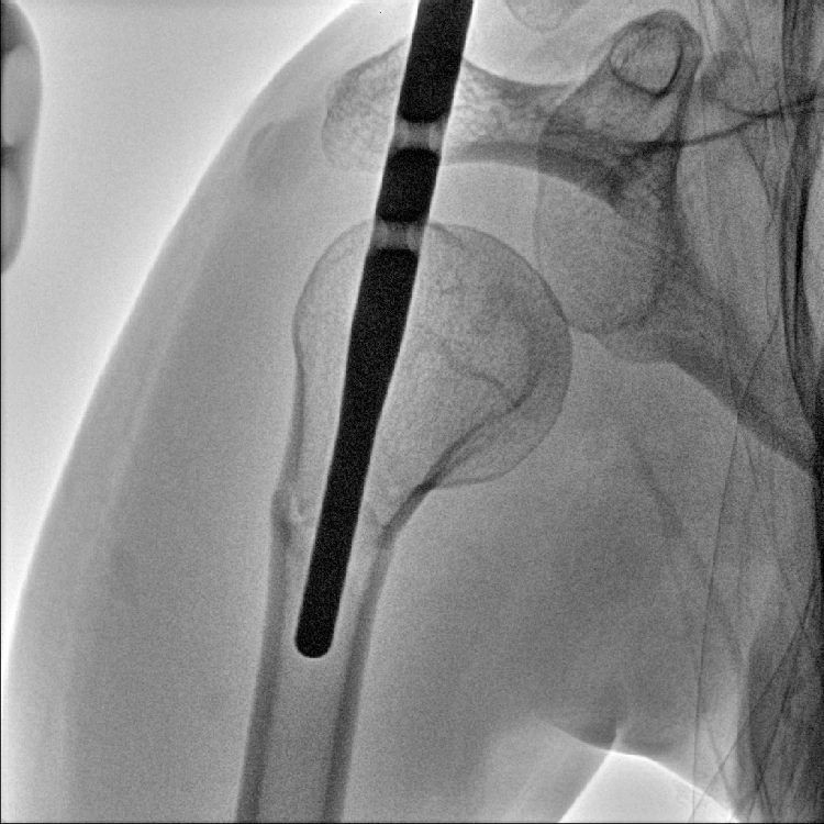 Manufacture price 5kw fluoroscopy radiology c arm x ray machine