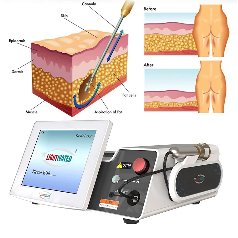 Endolaser 1470nm Spider Vascular Removal Machine 980nm Face Endo Jaw Lifting Laser Skin Rejuvenation Certified Medical Laser