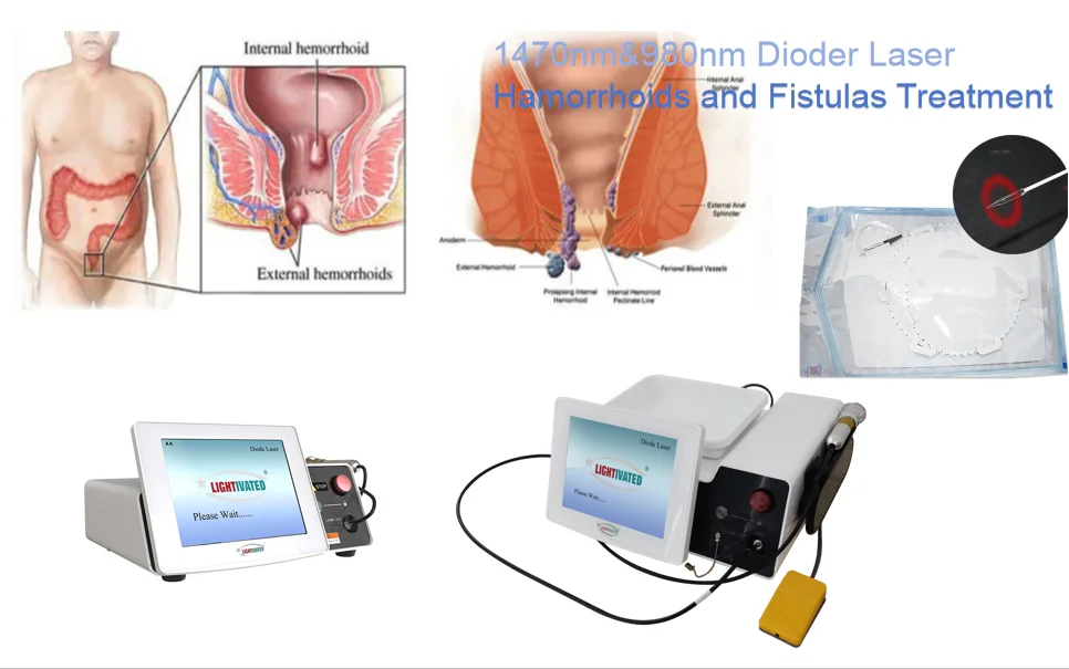 Hemorrhoids laser Fistula Prostate treatment 1470nm diode laser equipment Urology laser fistula rectal proctology Anorectal
