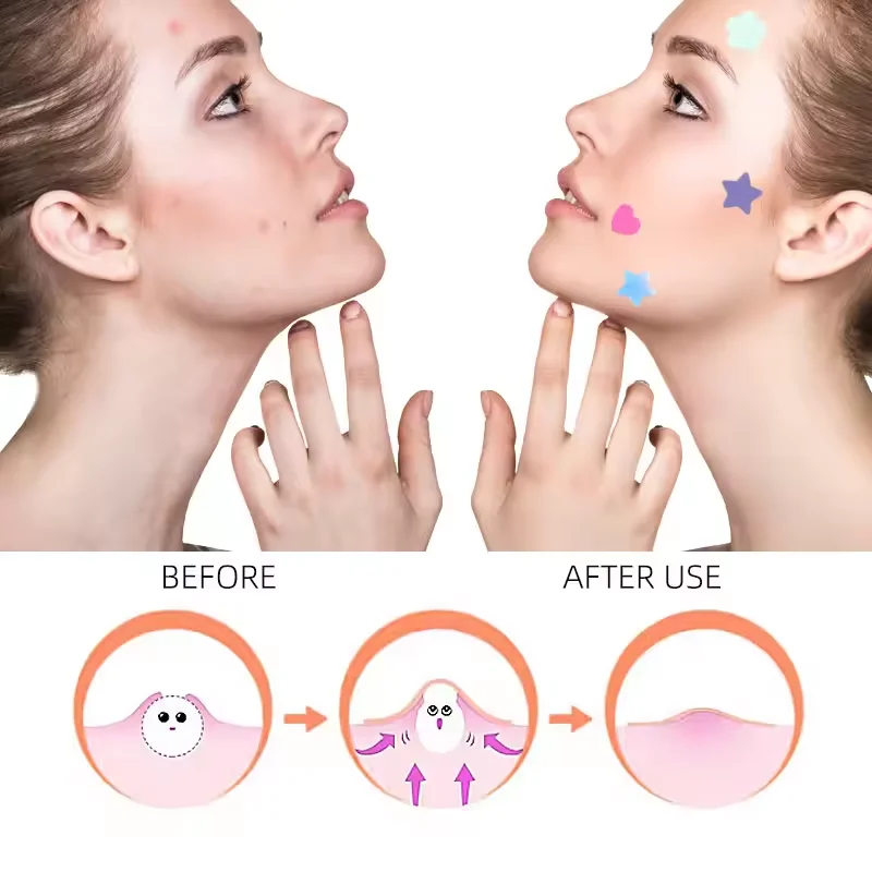 Zit Patch with Make-up Trouble Cure Anti Acne Sticker Face and Skin Organic Pimple Patch Acne